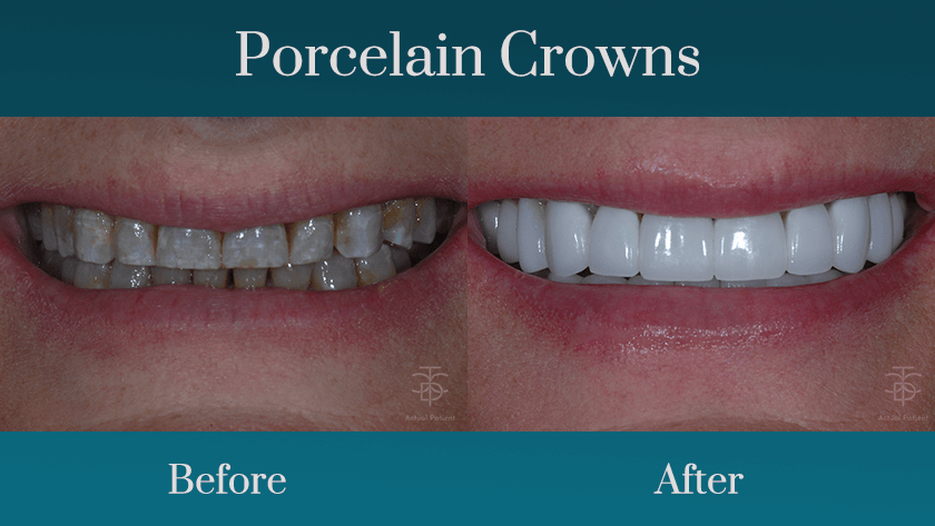 cosmetic dentistry before & af